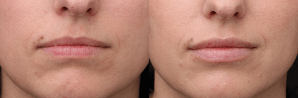 Lip Filler Redensify
