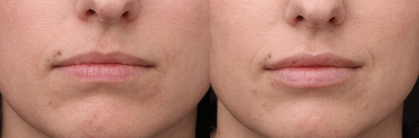Lip Filler Redensify