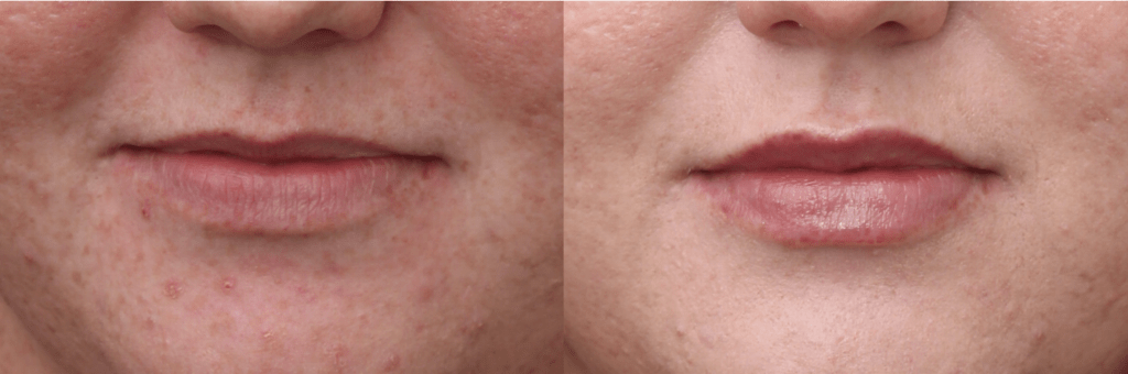 Lip Filler RHA