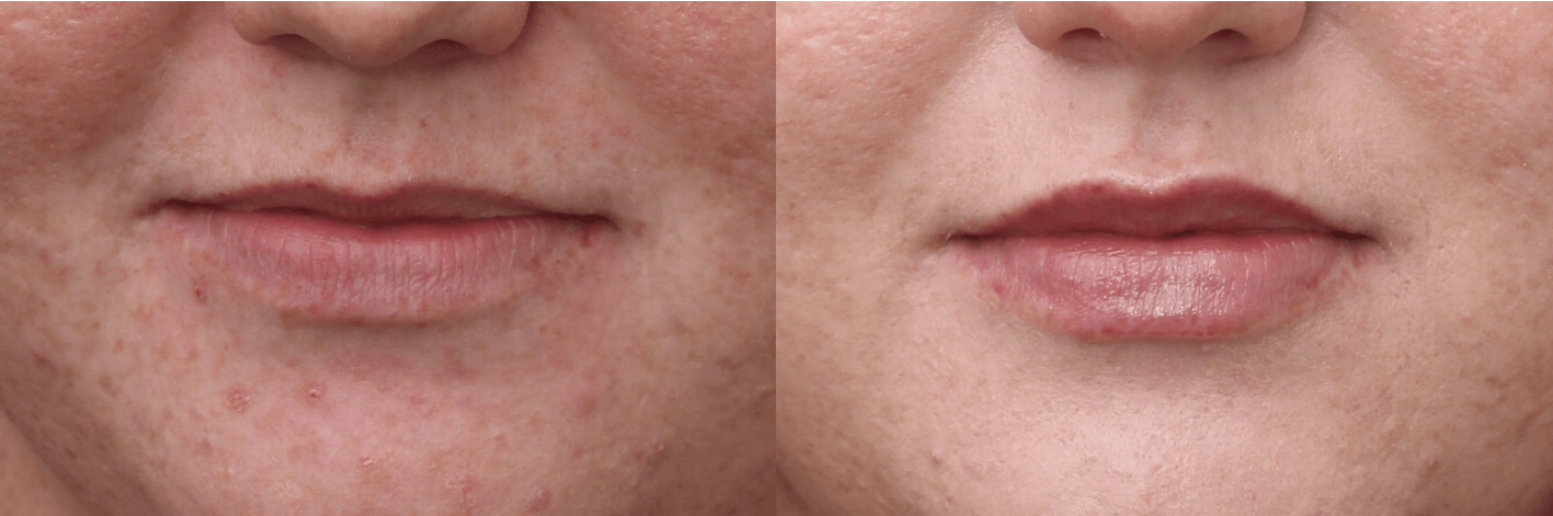 Lip Filler RHA