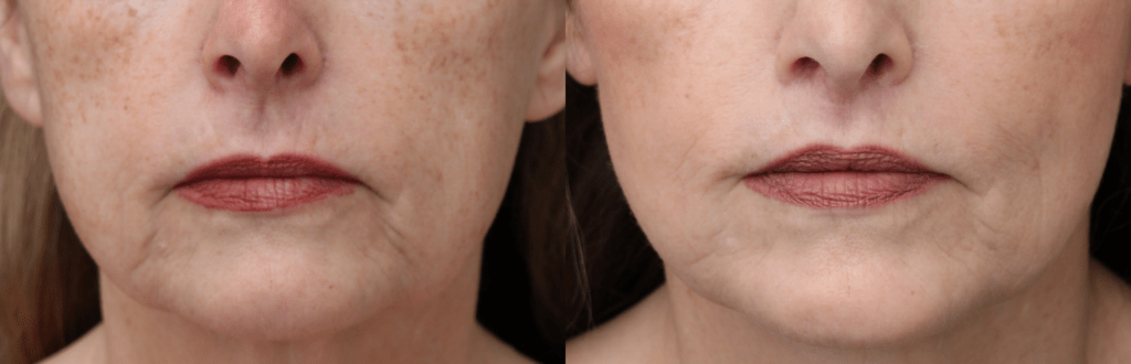Lip Lift