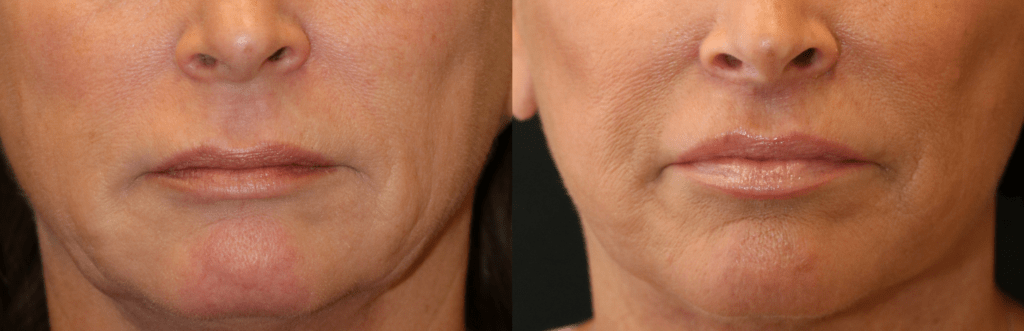 Lip Lift