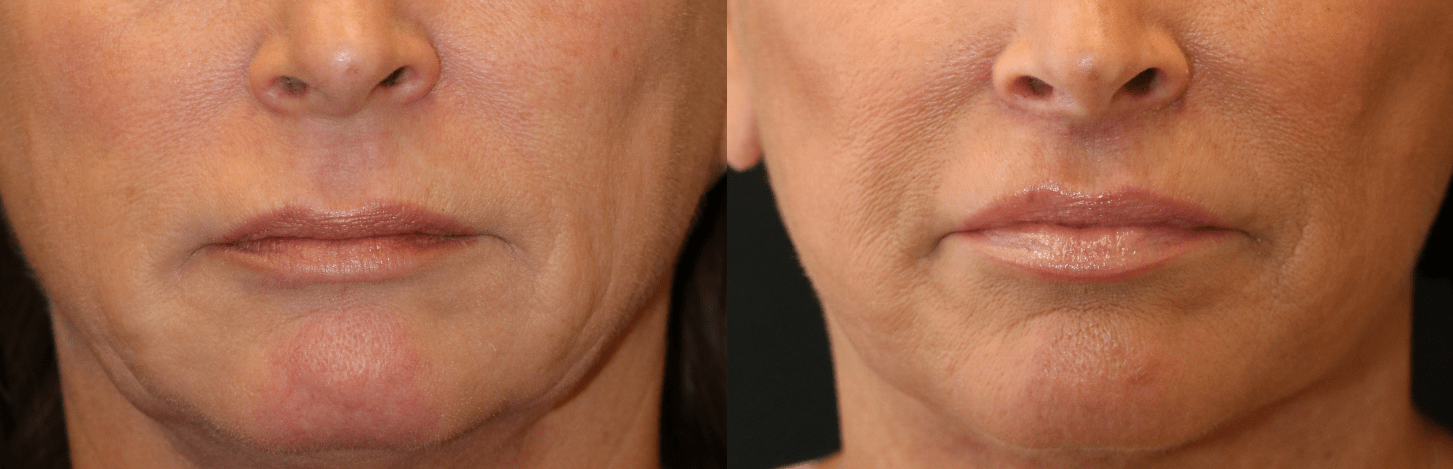 Lip Lift
