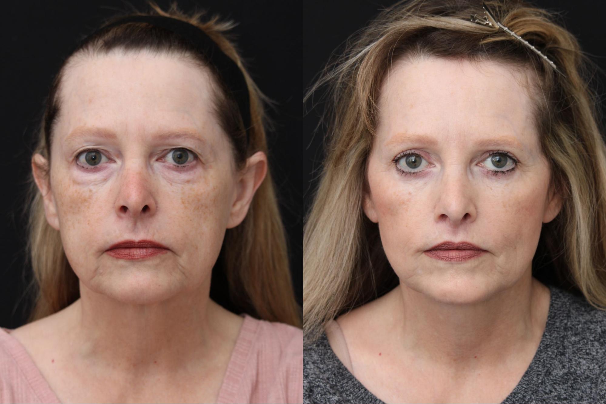 Upper Lower Bleph Face Neck Lift Lip Lift