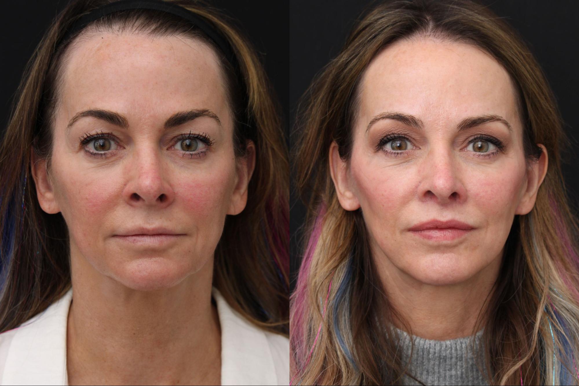 Blepharoplasty