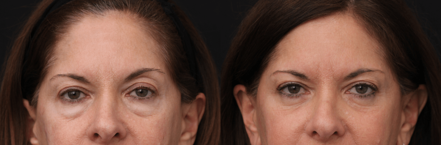 Lower Blepharoplasty