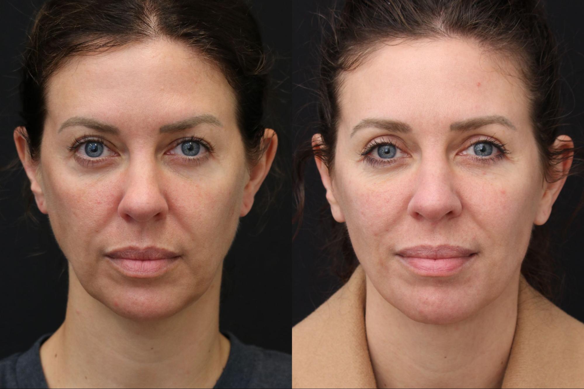 Face and Neck Lift + Blepharoplasty