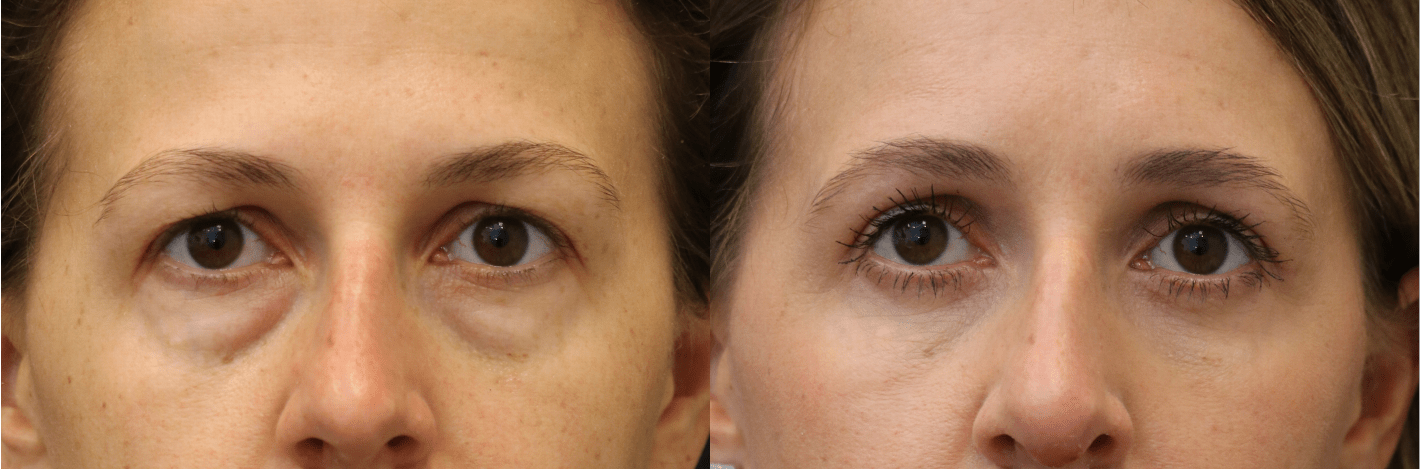 Lower Blepharoplasty