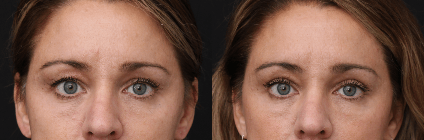 Upper Blepharoplasty