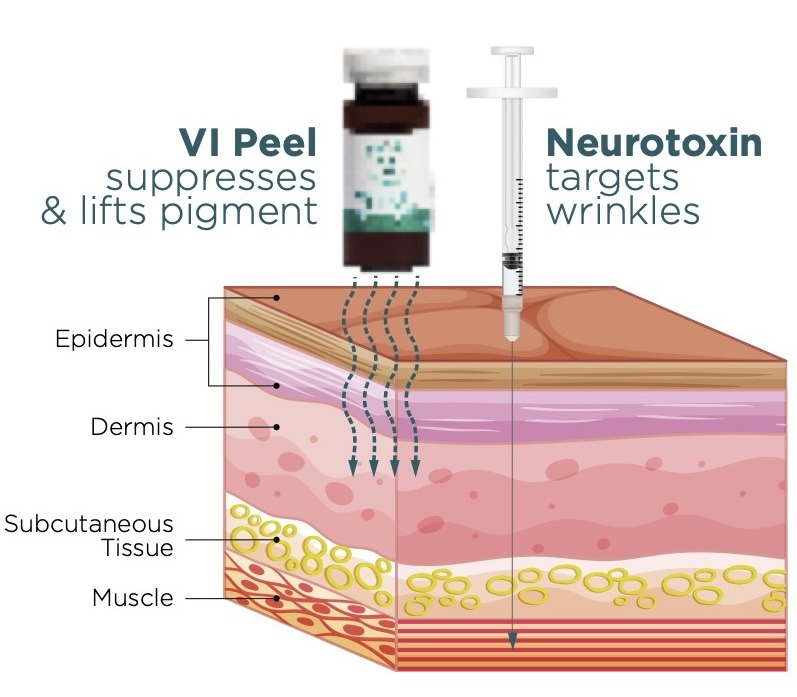 VI Peel