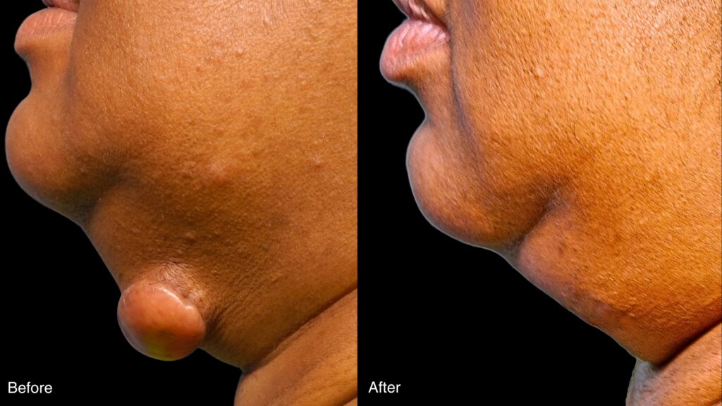 Keloid Removal