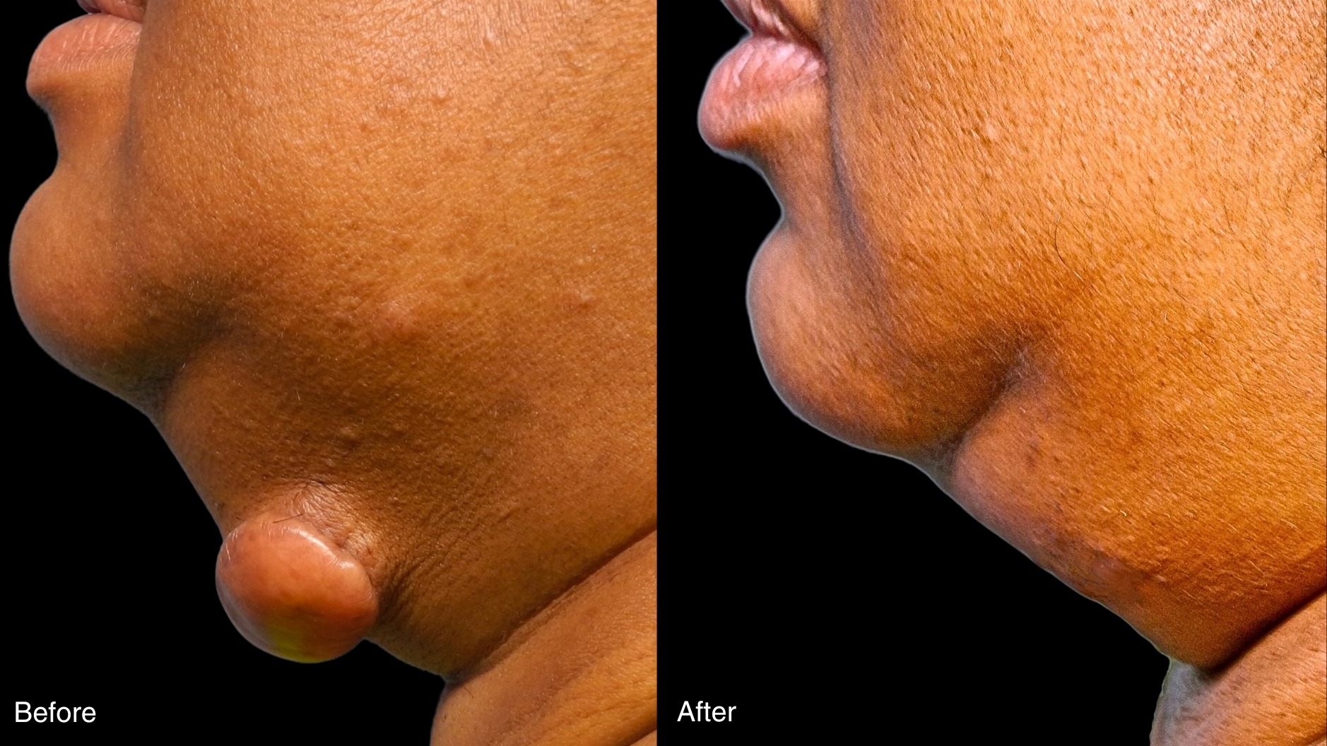 Keloid Removal