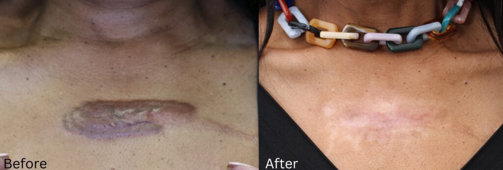 Keloid Removal