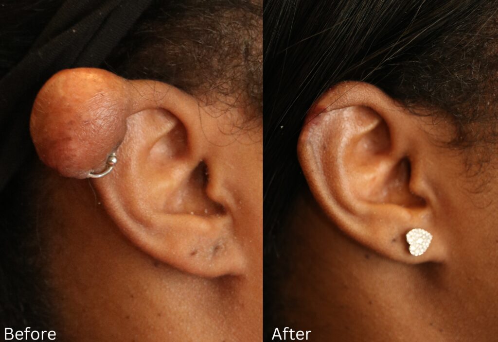 Keloid Removal