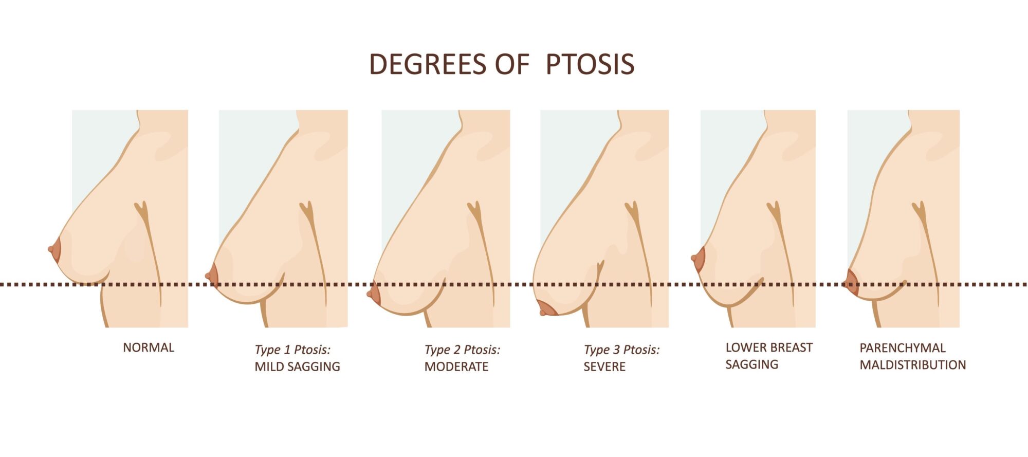 Breast Ptosis DrChernoff Breast Ptosis DrChernoff