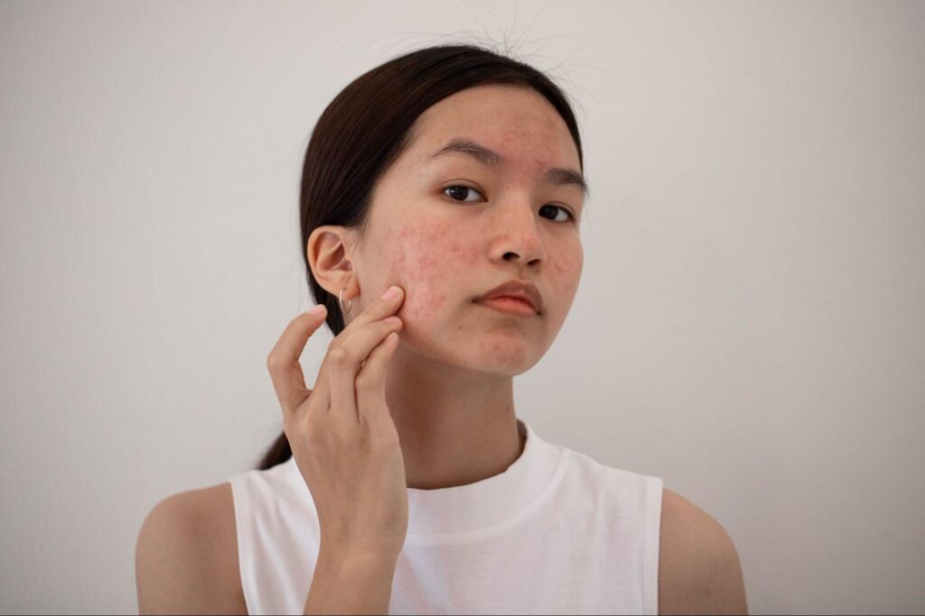 5 Tips to Improve Winter Acne