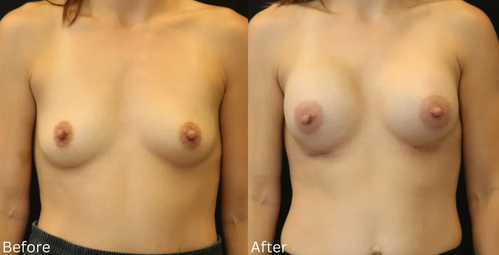 Before and After Ballerina Breast Augmentation in Santa Rosa, CA, by Chernoff Cosmetic Surgery