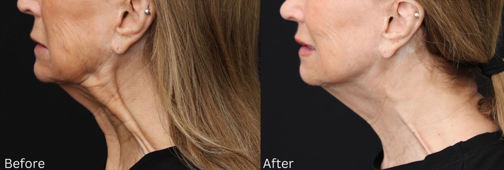 DrChernoff Nefertiti Lift 2 copy DrChernoff Nefertiti Lift 2 copy