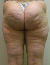 cellulite-01a-before