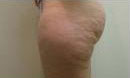 cellulite-01b-before