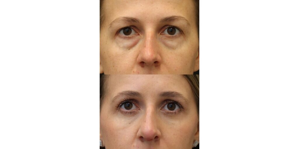 Everything You Need to Know About Eyelid Lift Surgery