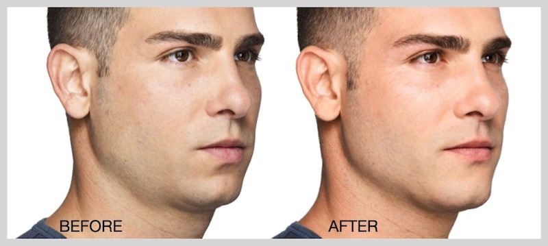 juvederm-volux-before-and-after-2
