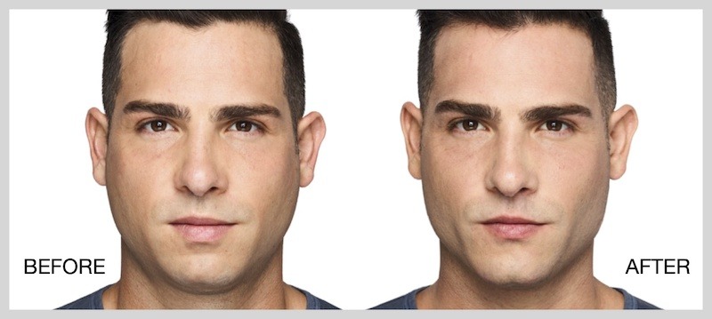 juvederm-volux-before-and-after