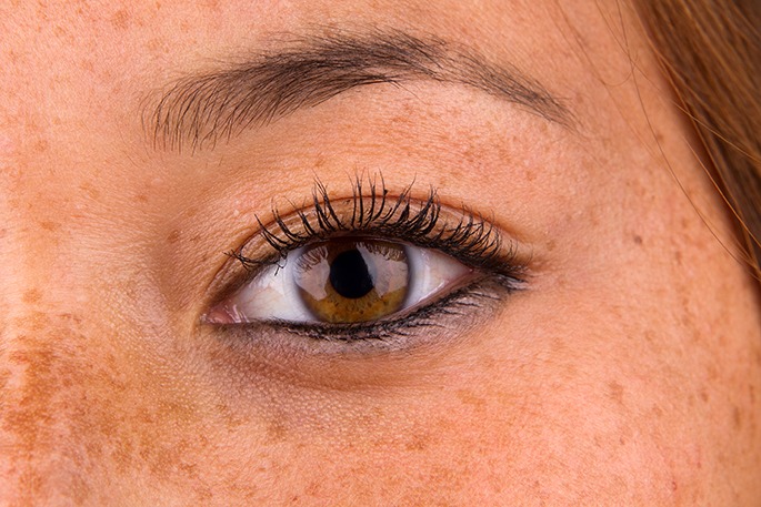 Close up of woman eye and surrounding skin showing sun damage commonly known as freckles.