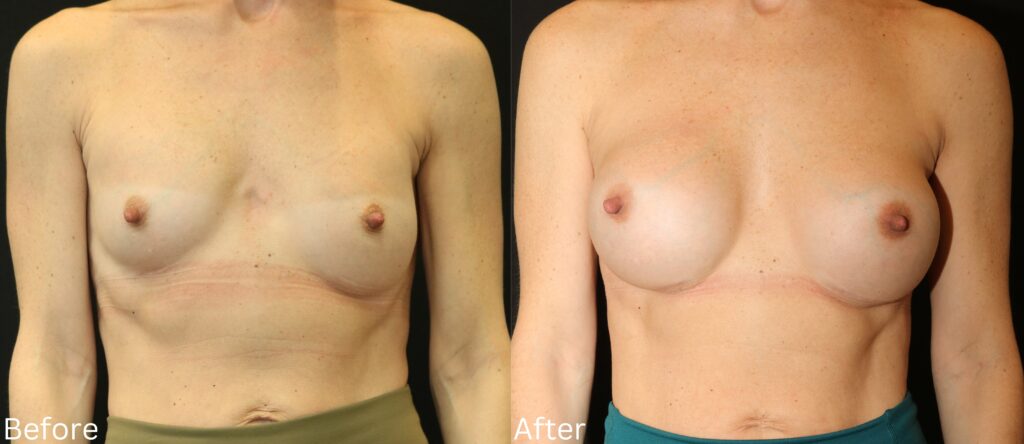 Breast Augmentation Santa Rosa