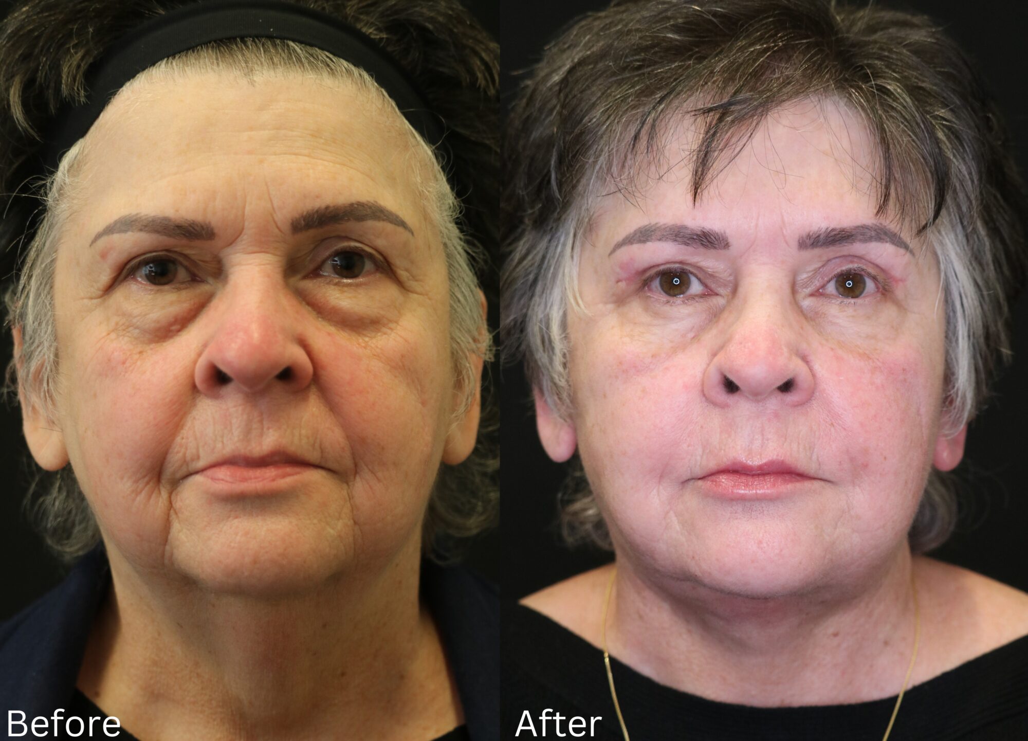 Total Facial Rejuvenation