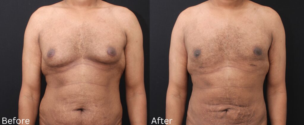 Male Breast Reduction