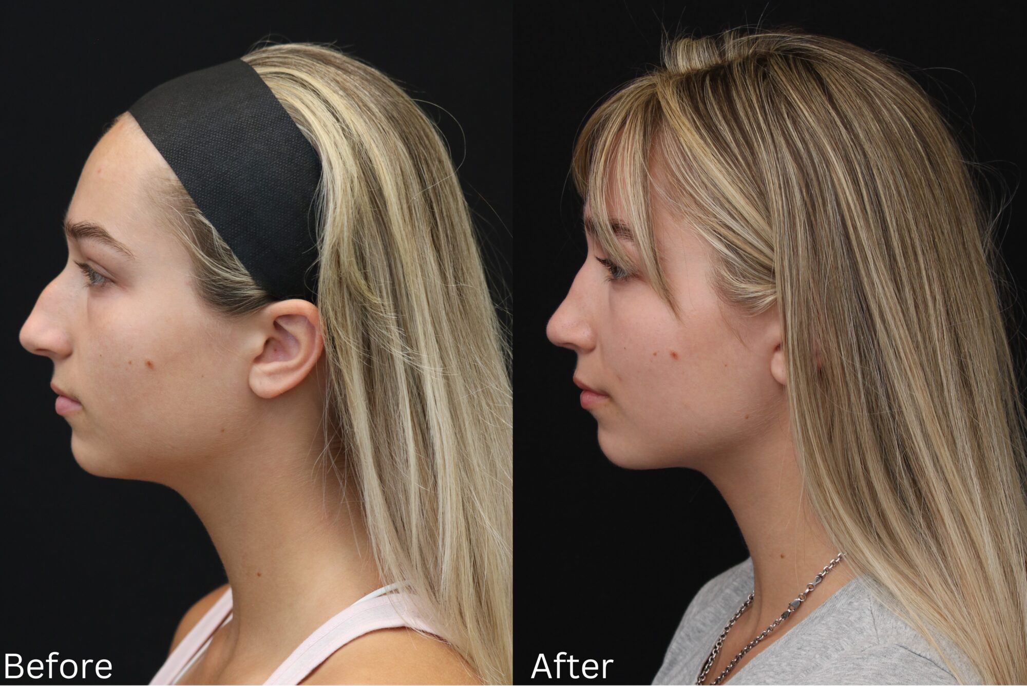 Rhinoplasty