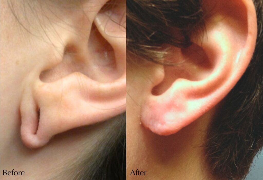 Earlobe Repair 1