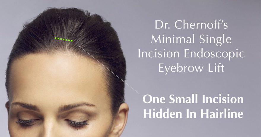 Endoscopic Eyebrow Lift DrChernoff 2