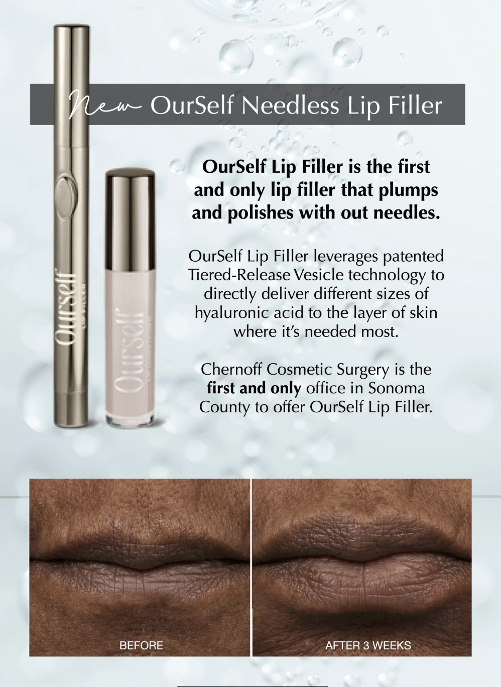 Ourself Lip Filler product at Chernoff Cosmetic Surgery