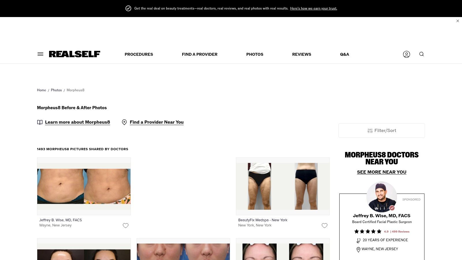 RealSelf &ndash; Morpheus8 Before & After Photo Library