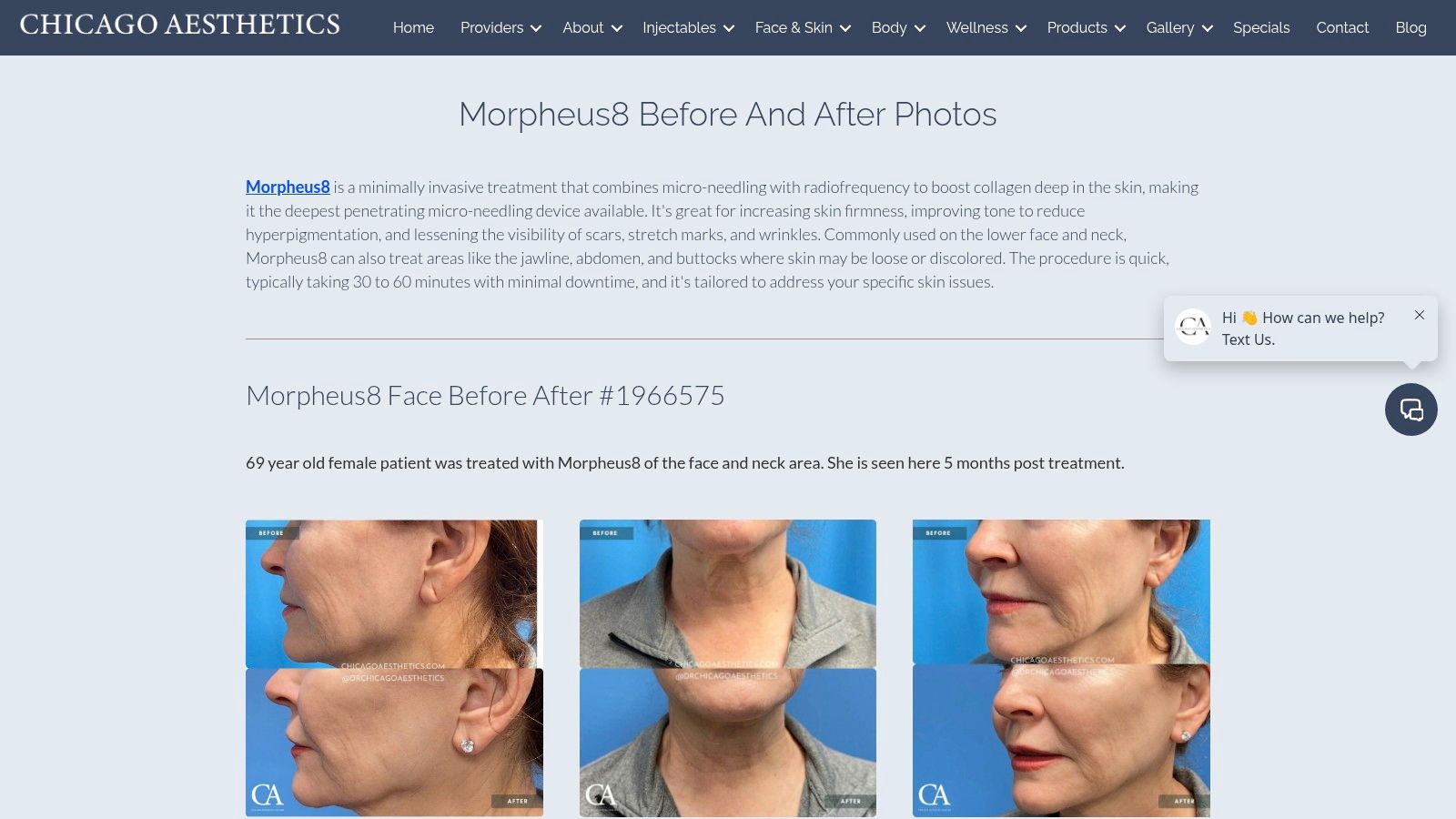 Chicago Aesthetics &ndash; Morpheus8 Before & After