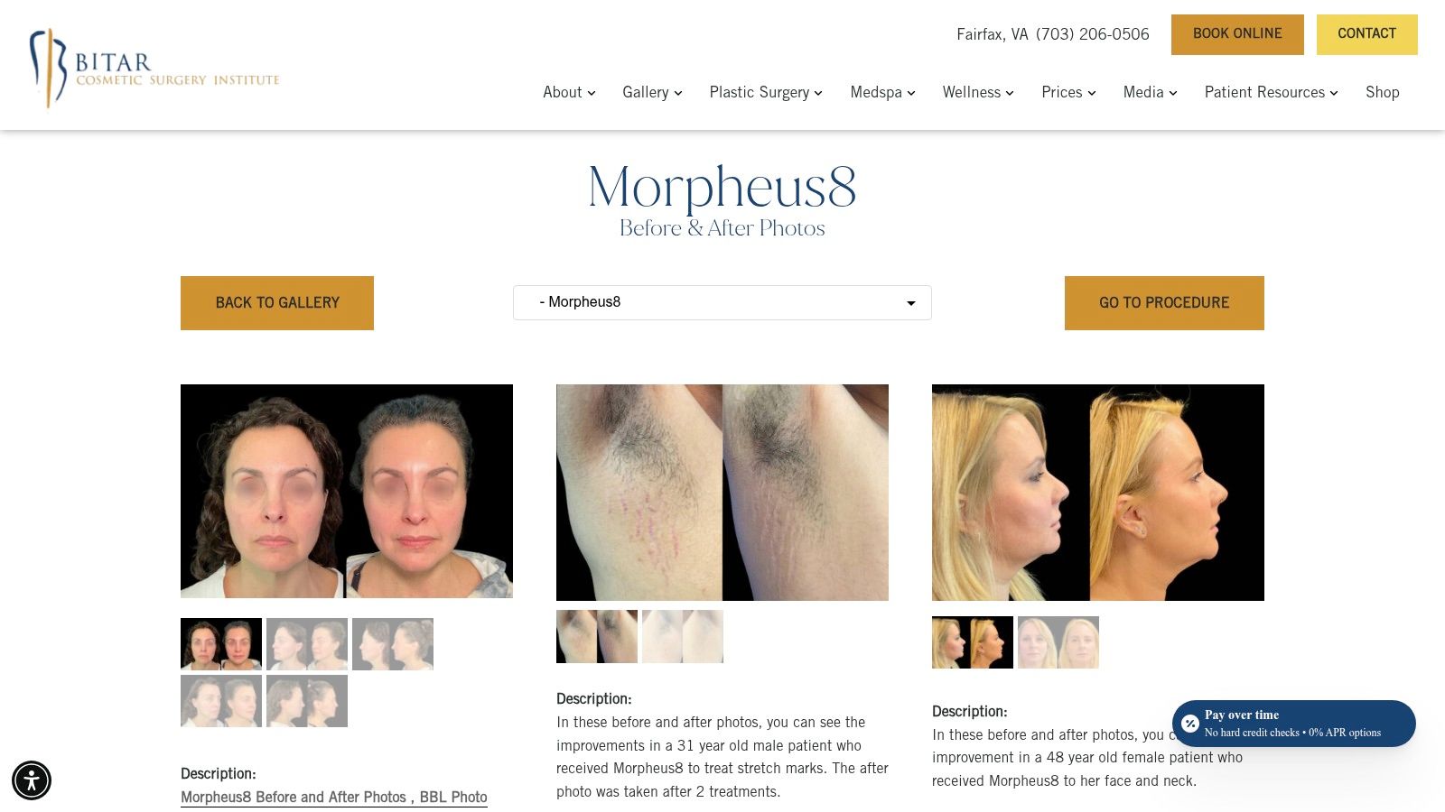 Bitar Cosmetic Surgery Institute (Fairfax, VA) &ndash; Morpheus8 Photos