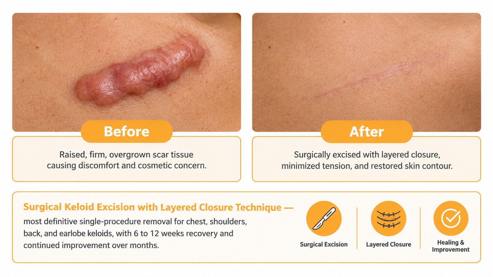 A before and after comparison of a patient who received surgical keloid removal with layered closure.